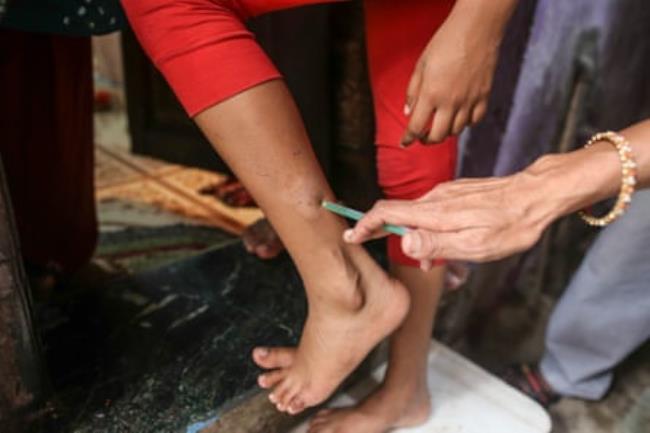 A woman points to marks on a girl’s leg 