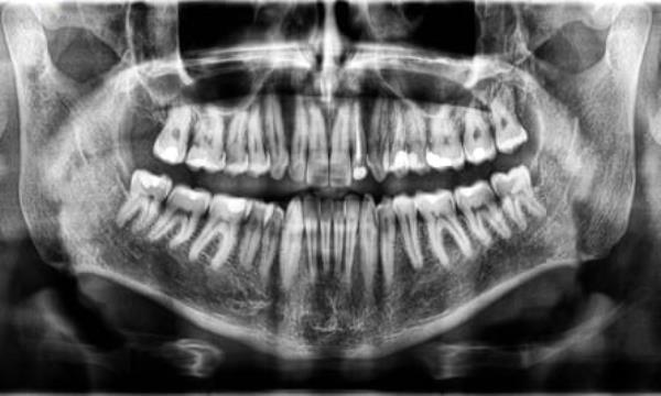 A 3D panoramic X-ray of a man’s teeth