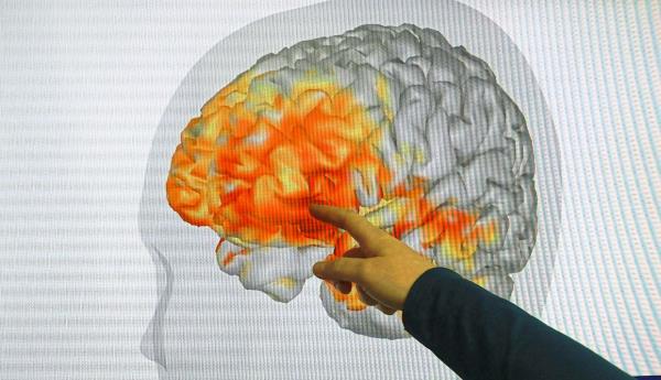 UTSW Assistant Professor of Radiology Dr Elizabeth Davenport pointing to an image of a brain impacted by a football concussion. — TNS