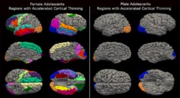 Brain scans of female and male adolescents showing accelerated cortical thinning