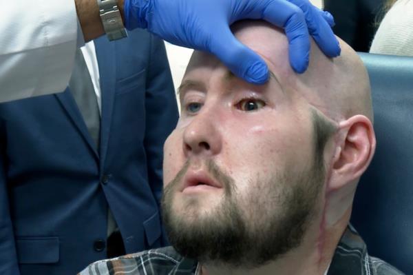 In May 2023, surgeons at NYU Langone Health made history when they replaced James' left eye and half his face, which he received from a donor in his 30s who had been declared brain dead. Here, he is getting examined on Nov. 7, 2023.