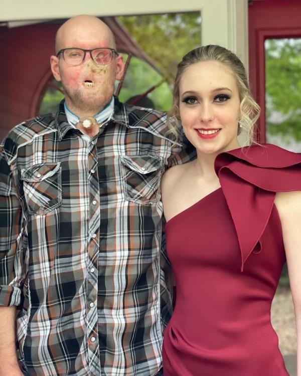 The utility line worker from Arkansas lost his left eye, left eyelid, nose, lips and a large amount of facial tissue when his face grazed a 7,200-volt live wire. Here, he's pictured with his daughter, Allie, 10 months after the accident, in April 2022.