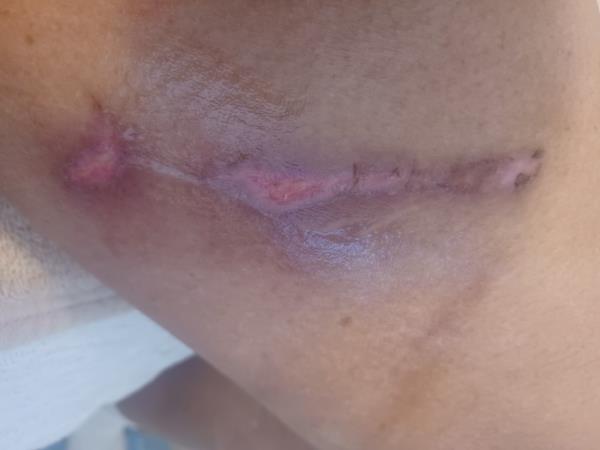 A photo of the scarring on Rawles' leg.