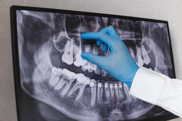 Dentist in gloves pointing at a filled root canal on a dental x-ray