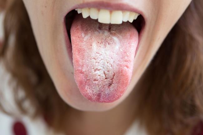 50-facts-about-candidiasis