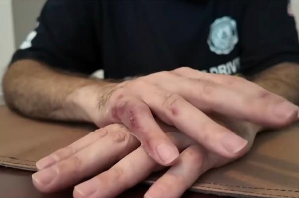 随着袭击的持续,这名男子在逃跑时被打了几拳,留下了膝盖上的淤青和手指上的针眼。