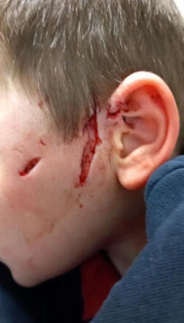 The injuries suffered by Jackson Flynn in the dog attack at the People's Park in Limerick. Picture: Brendan Gleeson The injuries suffered by Jackson Flynn in the dog attack at the People's Park in Limerick. Picture: Brendan Gleeson