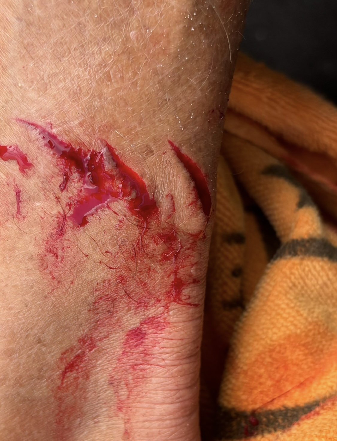 Shark bite marks on Charley Hajek's leg show fresh blood