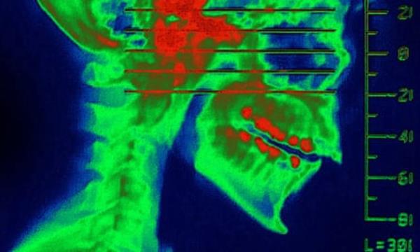 A stock image of a CT scan showing the jaw.