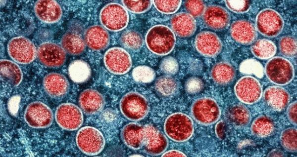 FILE - This image provided by the National Institute of Allergy and Infectious Diseases shows a colorized transmission electron micrograph of monkeypox particles (red) found within an infected cell (blue), cultured in the laboratory that was captured and color-enhanced at the NIAID Integrated Research Facility in Fort Detrick, Md. Kenya and the Central African Republic declared new outbreaks of mpox Wednesday, July 31, 2024, as Africa's health officials are racing to contain the spread of the disease in a region lacking vaccines. (NIAID via AP, File)